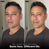 The Clear Skin Protocol