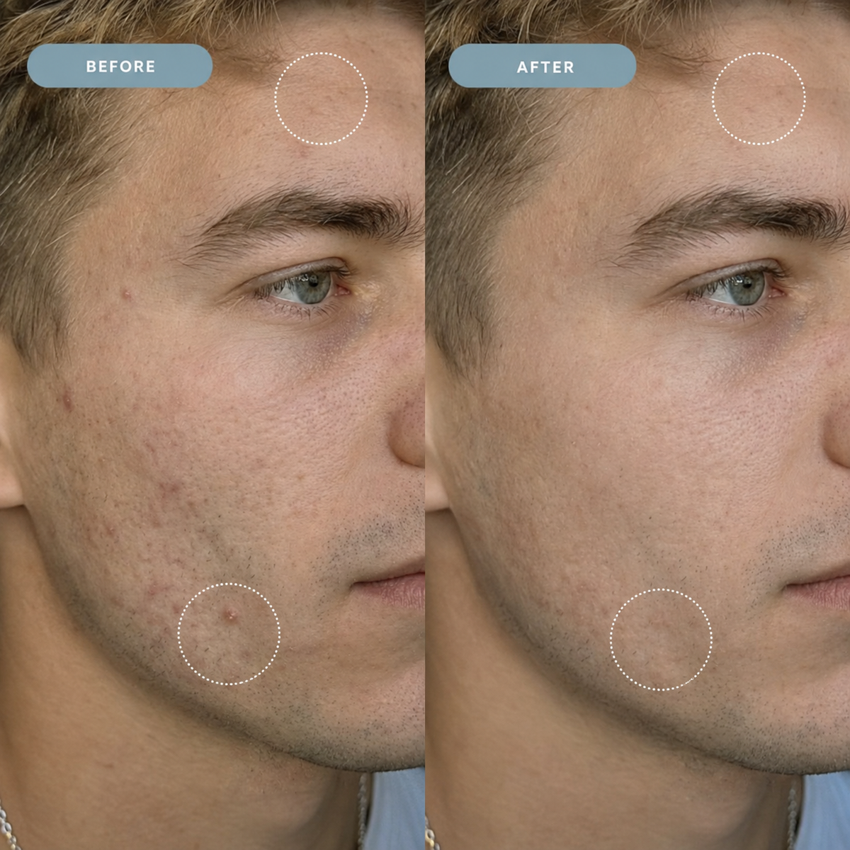 Aesthetic Lab® Pimple Patch