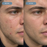Aesthetic Lab® Pimple Patch
